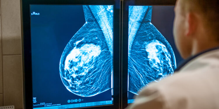 un-test-genetic-revolutionar-poate-oferi-milioanelor-de-paciente-cu-cancer-de-san-sansa-de-a-evita-chimioterapia-–-hotnews.ro