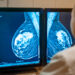 un-test-genetic-revolutionar-poate-oferi-milioanelor-de-paciente-cu-cancer-de-san-sansa-de-a-evita-chimioterapia-–-hotnews.ro